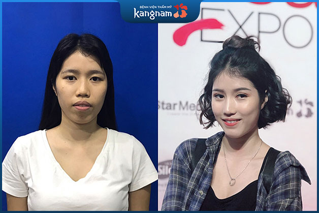 Ngô Quế An - Biến hóa ngoạn mục từ hàm hô trên dưới thành mặt V line chuẩn Hàn
