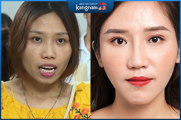 Nguyễn Hoàng Oanh - Mặt thon gọn như trẻ ra 10 tuổi sau phẫu thuật hàm hô