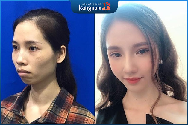 Phan Thị May lột xác hóa ngọc nữ xứ Hàn khi phẫu thuật cắt hàm hô tại Kangnam
