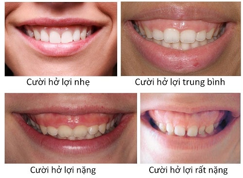 điều trị cười hở lợi giá bao nhiêu