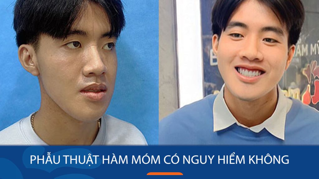 Phẫu thuật hàm móm có nguy hiểm không? Lưu ý trước và sau