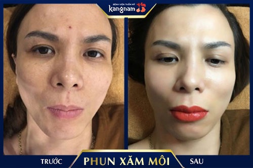 phun môi collagen có sưng không