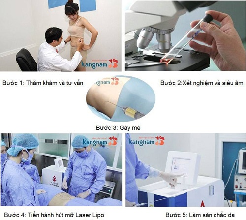 quy trình hút mỡ Kangnam an toàn