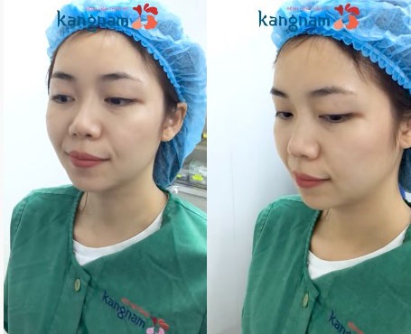 Tiêm Filler mũi cần KIÊNG những gì? Cách chăm sóc hiệu quả