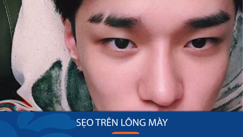 Sẹo trên lông mày: Nguyên nhân, cách điều trị và phòng ngừa