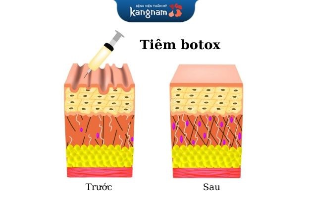 Tiêm botox tái cấu trúc da