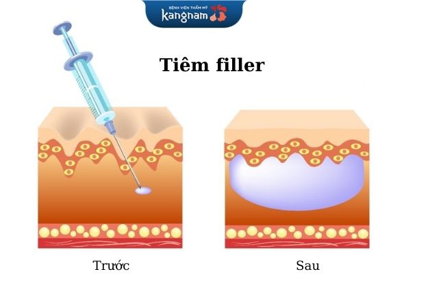 Tiêm filler botox có sự khác biệt