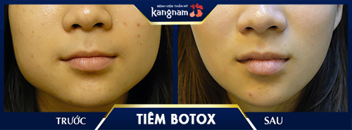 tiêm botox thon gọn mặt