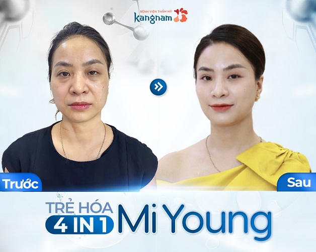 Chị Thoa hài lòng về dịch vụ trẻ hóa của Kangnam