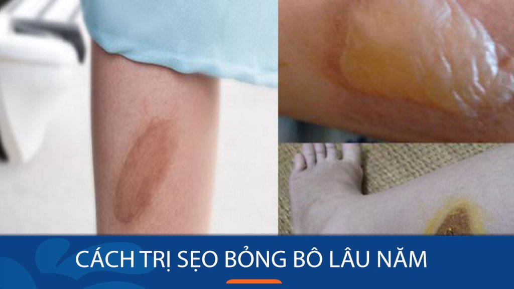 4 Cách trị sẹo bỏng bô lâu năm: Bí quyết đánh bay sẹo bỏng bô lâu năm chỉ trong 7 ngày