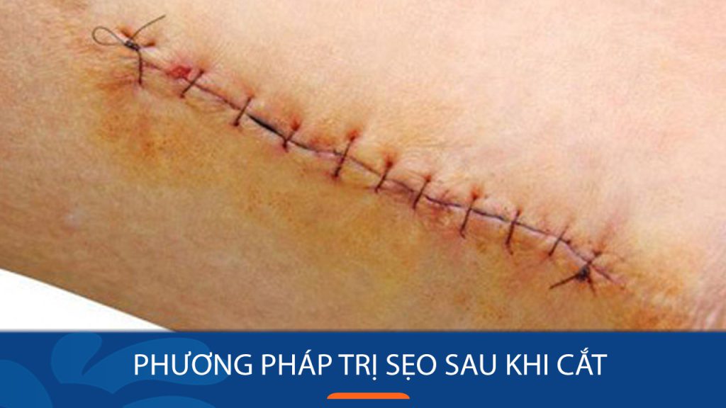 Cách trị sẹo sau khi cắt chỉ hiệu quả và nhanh chóng