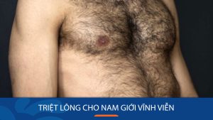 Triệt Lông Diode Laser Kangnam: Giải Pháp Hoàn Hảo Cho Làn Da Mịn Màng