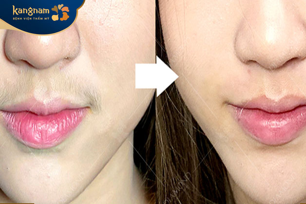 Triệt lông mặt giúp khách hàng sở hữu nét duyên dáng, nữ tính hơn