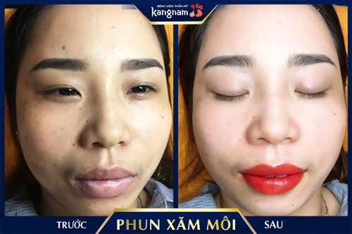 phun môi collagen giá bao nhiêu 