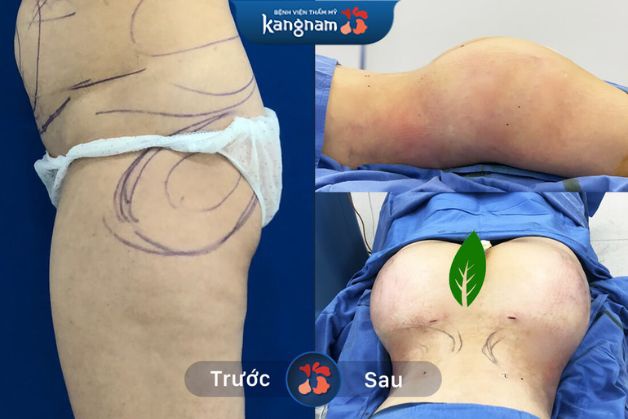 Hình ảnh vòng 3 căng đầy quyến rũ sau khi thực hiện nâng mông bằng công nghệ tại Kangnam