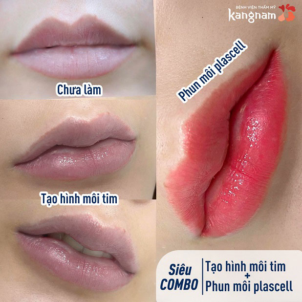 Kết quả khách hàng sau khi làm combo tạo môi tim và phun môi tại Kangnam