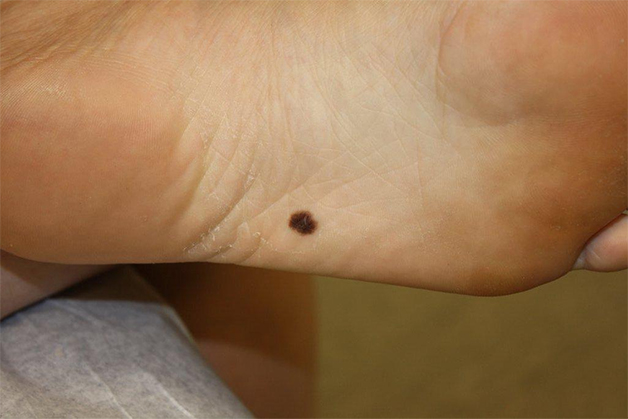 Tử vi nốt ruồi ở lòng bàn chân được coi là có số đại cát, đại lợi 