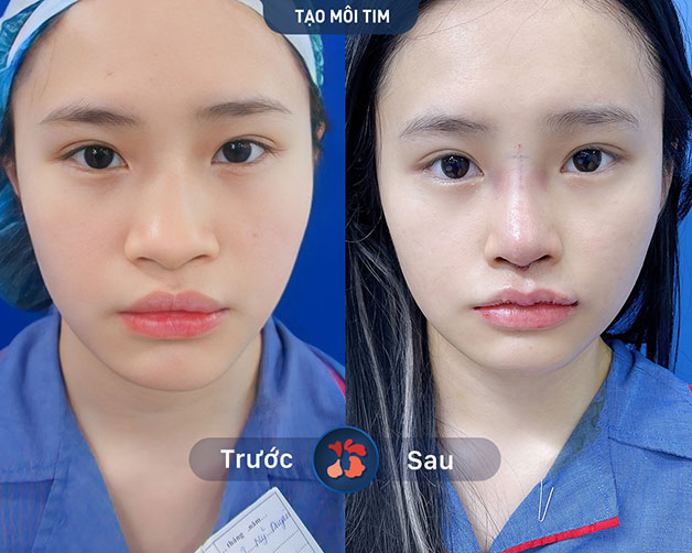 Trước và sau khi làm môi trái tim