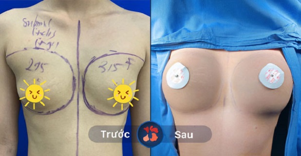Hình ảnh trước và sau khi nâng ngực tại Kangnam