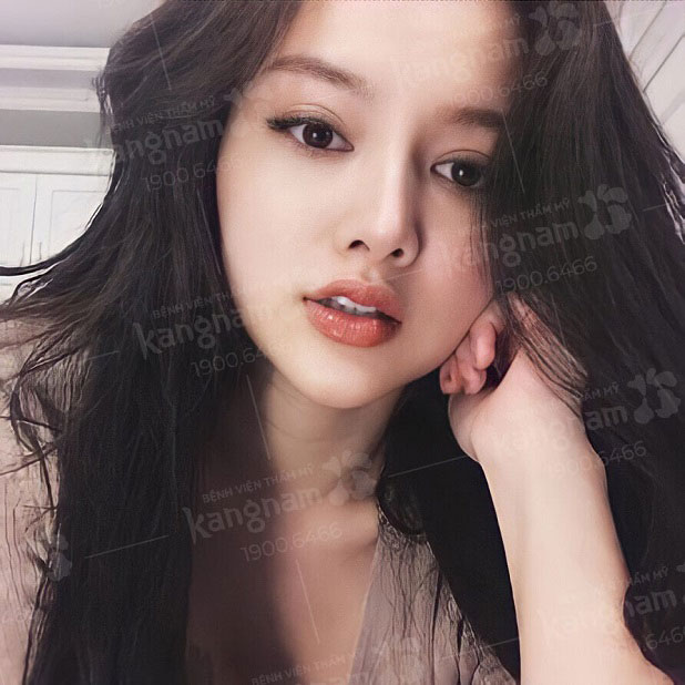 Tiêm filler mũi nhiều lần có sao không?
