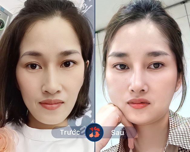 Gương mặt hốc hác, thô xương được thay thế bằng gương mặt đầy đặn, phúc hậu, trẻ trung hơn nhờ sử dụng dịch vụ cấy mỡ ở Kangnam