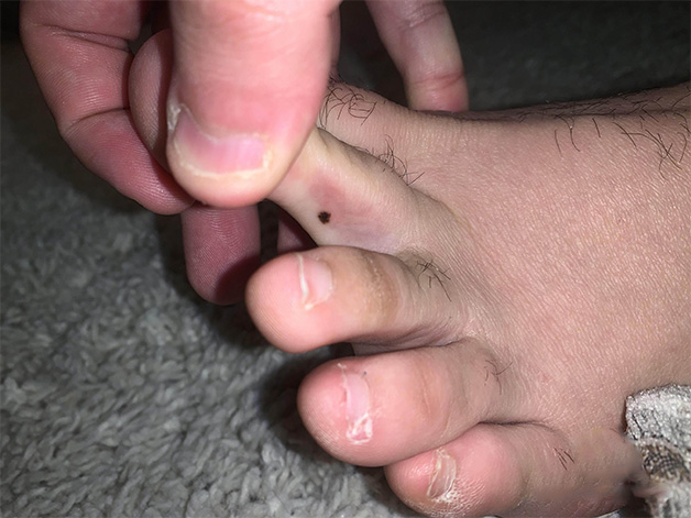 Nốt ruồi ở ngón chân giữa 