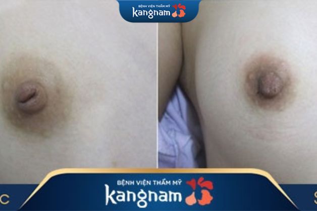 Hình ảnh khách hàng trước và sau khi thực hiện thu nhỏ quầng thâm vú tại Bệnh viện thẩm mỹ Kangnam 