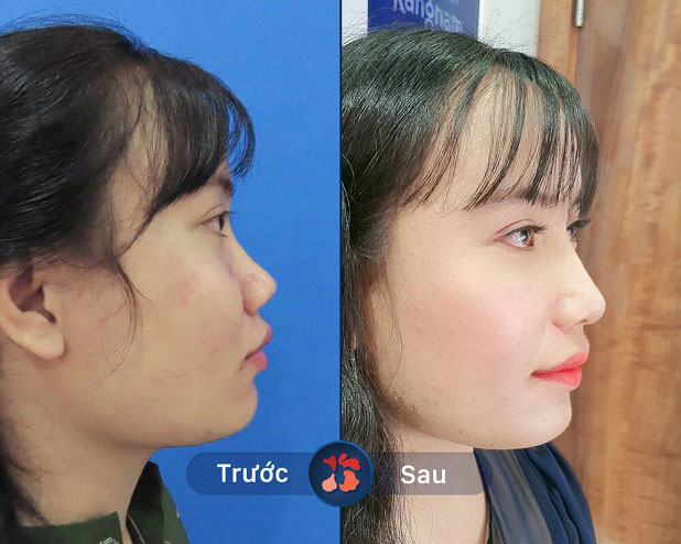 Khách hàng trước và sau khi nâng mũi