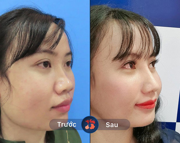 Trước và sau khi nâng mũi 