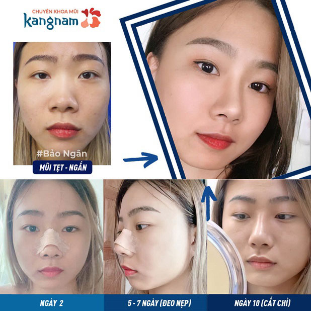 Quá trình hồi phục sau cắt cánh mũi tại Kangnam