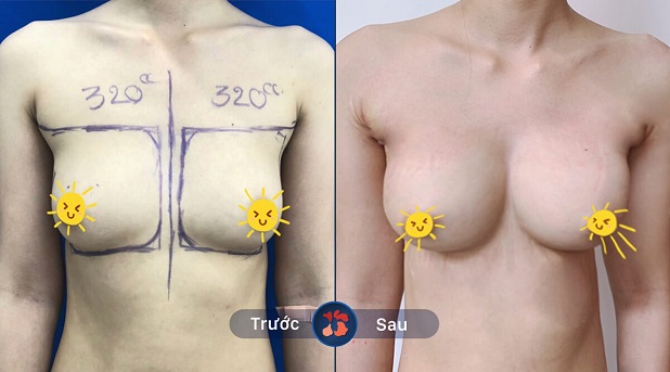 Hình ảnh trước và sau khi nâng ngực