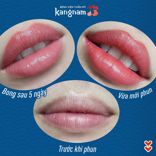 Kết quả phun môi tại Kangnam