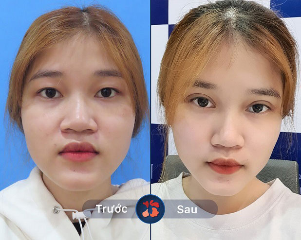 Trước và sau khi khách hàng cắt mí tại Kangnam