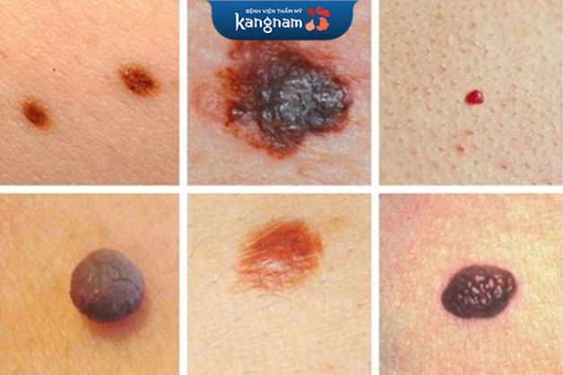 Đặc điểm nhận diện nốt ruồi bệnh lý, cảnh báo nguy cơ ung thư