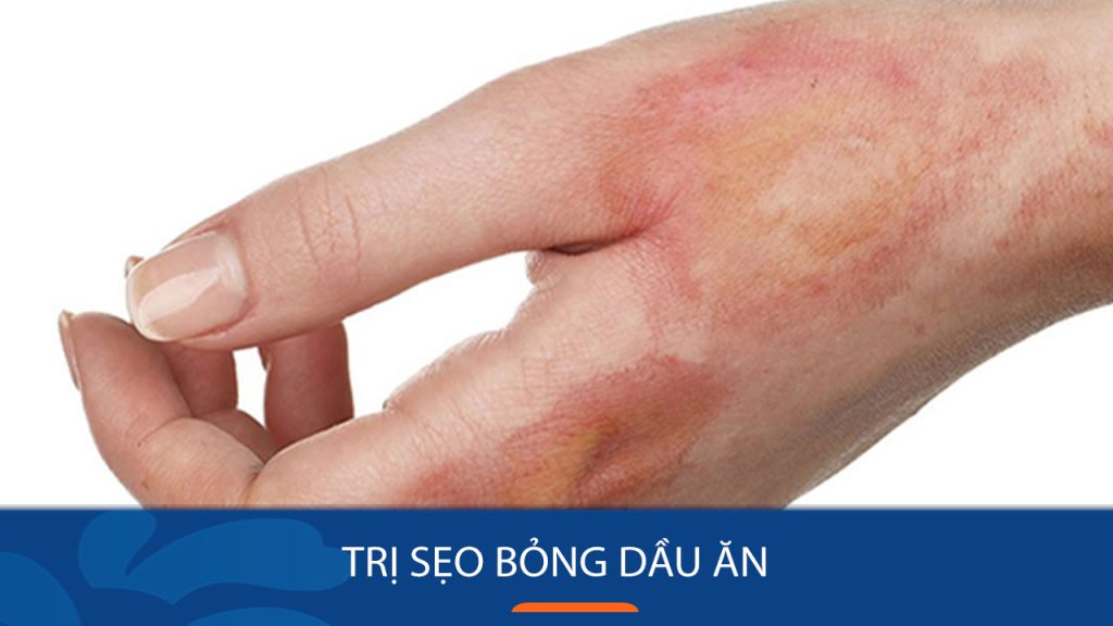 3 Cách trị sẹo bỏng dầu ăn Cấp Tốc – Nên dùng gì để trị sẹo bỏng dầu ăn?