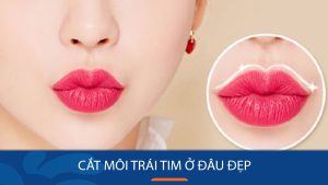 Cắt môi trái tim ở đâu đẹp? Bí quyết chọn địa chỉ thẩm mỹ uy tín