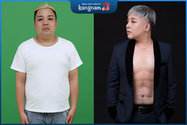 Body 6 múi nam tính sau giảm mỡ tại Bệnh viện Kangnam của ca sĩ Philipines