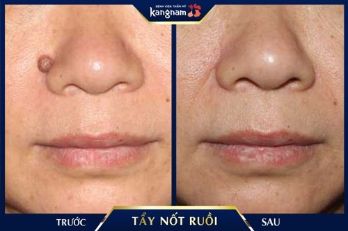 Nốt ruồi to mọc trên mặt nhiều năm của 1 khách hàng đã được tẩy sạch hoàn toàn, không để lại dấu vết