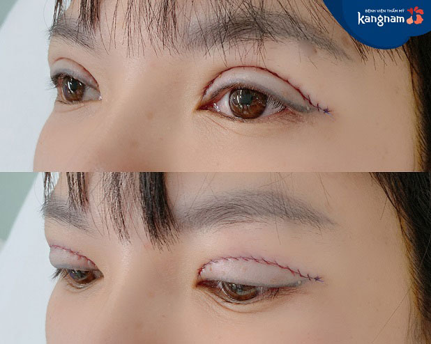 Kết quả khách hàng sau khi lấy da thừa mí mắt tại Kangnam