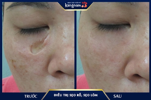 Công nghệ Scar Nano tìm lại vẻ đẹp rạng ngời, làn da phẳng mịn cho 1 khách hàng nữ bị sẹo lõm nặng do tai nạn