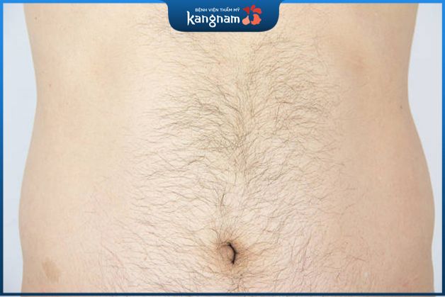 Lông bụng mọc ngược là hiện tượng khi lông trên vùng bụng mọc theo hướng ngược lại so với mọc tự nhiên
