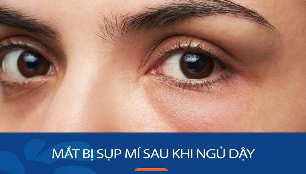 Mắt bị sụp mí sau khi ngủ dậy – Một số Nguyên nhân chủ yếu