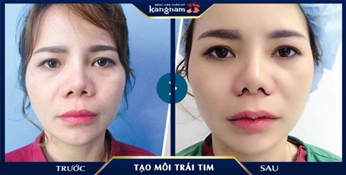 môi trái tim nữ