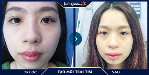 môi trái tim tự nhiên