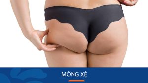 Mông xệ – Nguyên nhân và cách khắc phục triệt để cho vòng mông