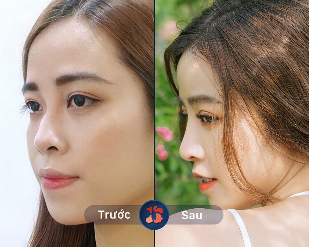 Kết quả trước và sau khi khách hàng nâng mũi tại Kangnam
