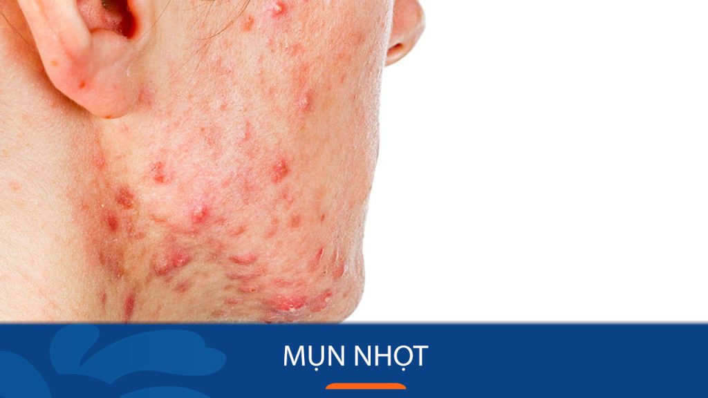 Mụn nhọt không còn là nỗi lo! – Bí quyết trị mụn hiệu quả dành cho bạn