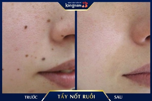 Gương mặt quá nhiều nốt ruồi của chị H (Hà Đông) đã được thay thế bằng làn da hồng hào, mịn màng, không tì vết