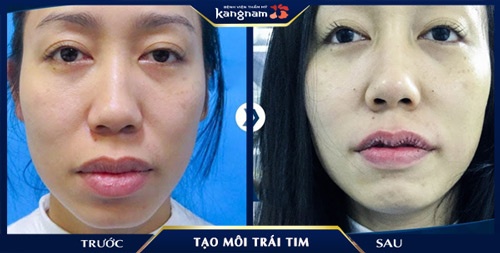 người có môi trái tim