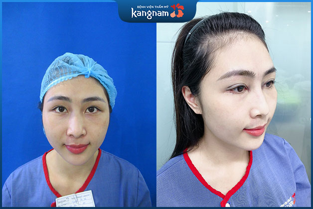 Trước và sau khi khách hàng nhấn mí tại Kangnam